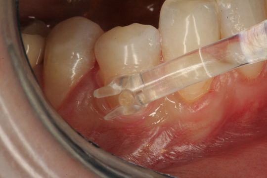 přiložení plastové matrice na krček zubu