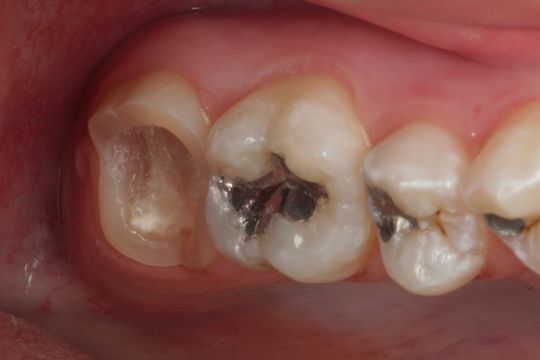 zub preparovaný na celokeramickou overlay